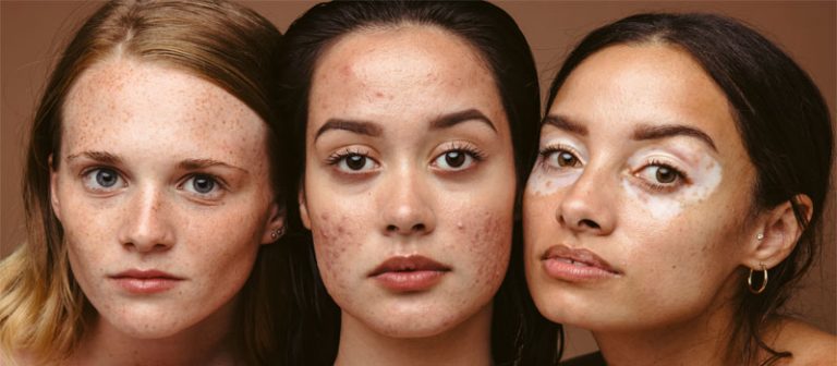 Top 7 Acne Supplements to Treat and Calm Acne