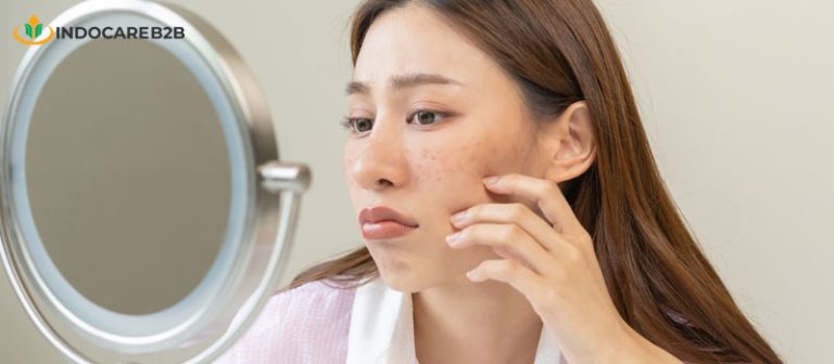 Tips Jitu Menciptakan Produk untuk Menghilangkan Flek Hitam