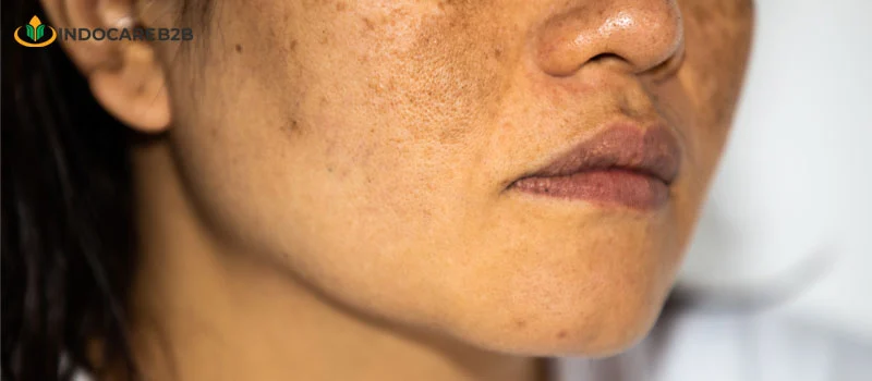 3 Cara Menghilangkan Merkuri di Wajah: Potensi Bisnis